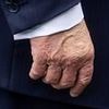 White House reveals Trump's 'chronic' health condition as he suffers swelling and bruises