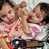 Conjoined twins attached at the chest, belly and pelvis are successfully separated in painstaking 15-hour operation