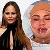 Chrissy Teigen's gruesome mystery surgery REVEALED after she sparked worry with bandaged face