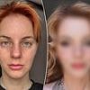 Why we got facelifts in our 20s and 30s: see the before and after pictures and judge results for yourself