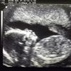 Extra echo kan voorspellen of bevalling moet worden vervroegd om baby te redden