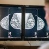 Borstkanker bij veel vrouwen slecht zichtbaar op röntgenscan: plan voor MRI