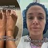 Woman reveals how a simple splinter lead to years of excruciating pain and seizures