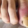 I thought my swollen fingers and toes were harmless... but cancer had 'replaced' my bones with tumors