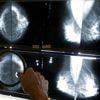Cancer before age 50 is increasing. A new study looks at which types