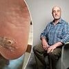 This 'stain' on Magnus's skin was sign he had a deadly but common cancer. Now doctors reveal brown marks and 'bruises' NEVER to ignore and unusual places to look for them