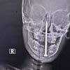 Seven-year-old boy has three-inch nail removed from his BRAIN by incredible surgeons after he fell on it in horrific India playtime accident