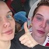 Helen Flanagan, 34, sports painful looking black eye after undergoing £400 cosmetic injections