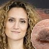 How concerned should I be about my crusty brown skin patches? Dr Ellie reveals whether you should be worried about cancer
