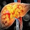 Experts pinpoint cause of surging rates of liver cancer - as cases surge in under 50s with numbers set to DOUBLE by 2050