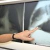 Krankenkassen zahlen: Lungenkrebs-Früherkennung für Raucher kommt - unter Bedingungen