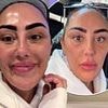 Sophie Kasaei shows off dramatic results of getting face filler dissolved at £30m Botox clinic after an allergic reaction left her with PTSD
