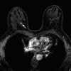 MRI-scan om vroegtijdig borstkanker op te sporen kan veel sneller