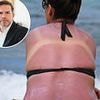 I applied factor 50 sun cream but still got badly burnt - can I get compensation? Consumer lawyer DEAN DUNHAM replies