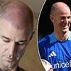 Former England goalkeeper Joe Hart sports fresh scars of hair transplant at Soccer Aid... in a far cry from his days in Head and Shoulders adverts!