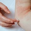 Concern as skin condition that hits millions is linked to raised risk of suicide