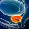 AI test could help to cut the risk of dying from prostate cancer by half, study suggests