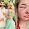 Heartbroken bride issues urgent warning after routine, pre-wedding 'glow-up' left her 'blind in one eye'