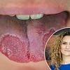 What to do about a crusty white tongue: DR ELLIE reveals what it means about your health, how to get rid of it... and when you should be concerned about cancer