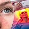 It's a cruel illness that blights the lives of millions. But there's new hope for rosacea patients with this amazing therapy developed to treat cancer