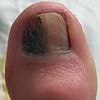 GP said the mark on my toenail was just an infection... in fact it was the first and only sign of deadly cancer
