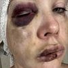Horrific new photos show woman's monstrous injuries after being knocked out during Cincinnati brawl