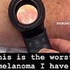 Skin cancer doctor shares shocking video of 'worst melanoma' he's ever seen: 'They don't always look like moles'