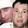 My schizophrenic uncle set me on fire leaving half my body covered in horrific burns - but this is how I look now thanks to a revolutionary new surgery