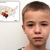 America's measles outbreak reaches terrifying milestone... and what 96% of the infected have in common