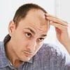 Cancer specialists warn of critical mistake people with thinning hair make as heatwave grips the UK