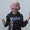The six-year-old albino boy whose hand was hacked off by his FATHER to make potions for witchdoctors in Tanzania