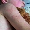 Mazelen verspreiden zich sneller: vijftig nieuwe gevallen in één week