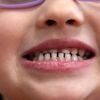 FDA and RFK Jr. aim to remove fluoride supplements used to protect kids' teeth