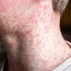 Cases of the world's most infectious disease keep climbing in the UK - with two major areas most at risk