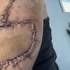 Pictured: The 'normal' mole on mother's arm that turned out to be deadliest skin cancer - she ignored it for 4 years