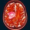 Hundreds of women ready to sue over contraceptive jab linked to brain tumours - as doctor warns prescribing drug 'verges on medical negligence'
