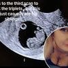 I was pregnant with triplets but only delivered one baby after my son 'ate his siblings' in the womb