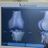 Les industriels du secteur des prothèses orthopédiques alertent sur un risque de pénuries d'implants