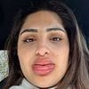 Horrific reaction to popular cosmetic tweak leaves woman, 24, looking like a Bratz doll