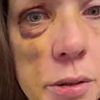 Cincinnati woman beaten to a pulp in street fight that shocked America reveals she's been left with brain trauma