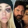 Denise Richards' estranged husband gives new explanation for her black eye as divorce turns messy
