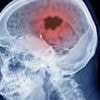 Medic demonstrates the 30-second hand test that could reveal if you have a hidden brain tumour