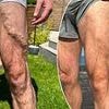 What CAN I do about the ugly, lumpy veins in my legs? Top surgeon reveals the treatments that actually work... and the one to avoid