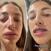 Woman reveals what REALLY happens when you get lip filler dissolved