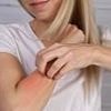 One in four women say menopause triggered eczema symptoms