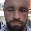 MAFS star sparks concern as he shares photos of his swollen head in post hair transplant surgery pics
