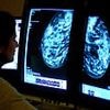 Fresh calls for health chiefs to give breakthrough breast cancer drug green light as pivotal trial shows it boosts survival