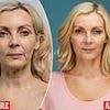 I was 52 with a collapsed 'turkey neck'. Here's how I turned back the clock 10 years