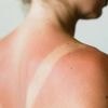 Qu’est-ce que l’empoisonnement au soleil, dont les symptômes doivent alerter ?