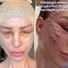 Rise of patchwork facelift techniques that leave patients with eye-watering stitches - as surgeons say painful-looking method heals FASTER